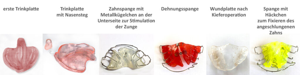 Trinkplatte, mit Nasensteg, Zahnspange, Dehnungsspange, Wundplatte nach Kieferoperation