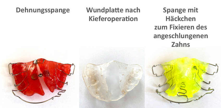 Dehnungsspange, Wundplatte nach Kieferoperation